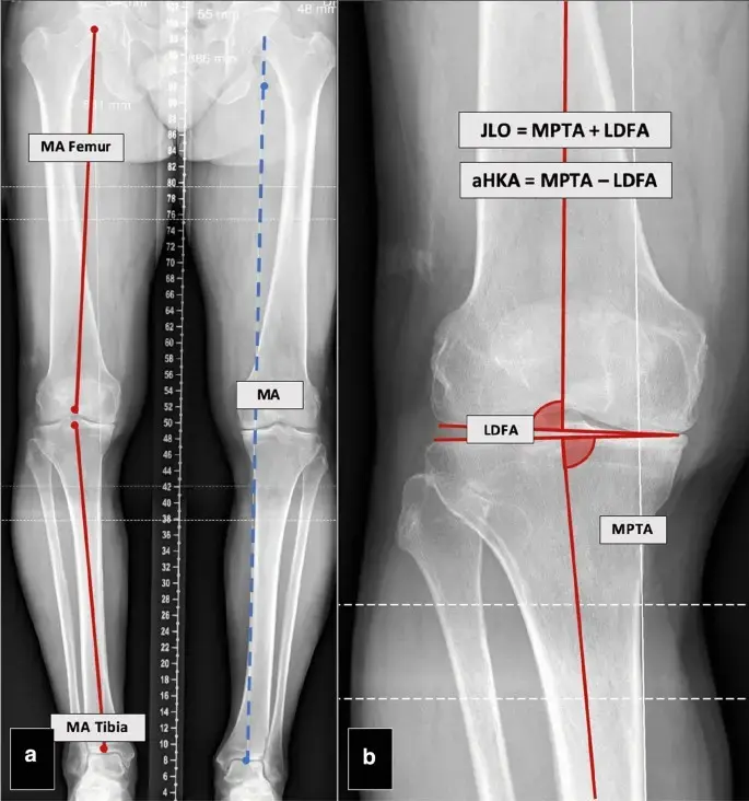 X-ray to 3D CT Reconstruction & Knee Alignment Analytics